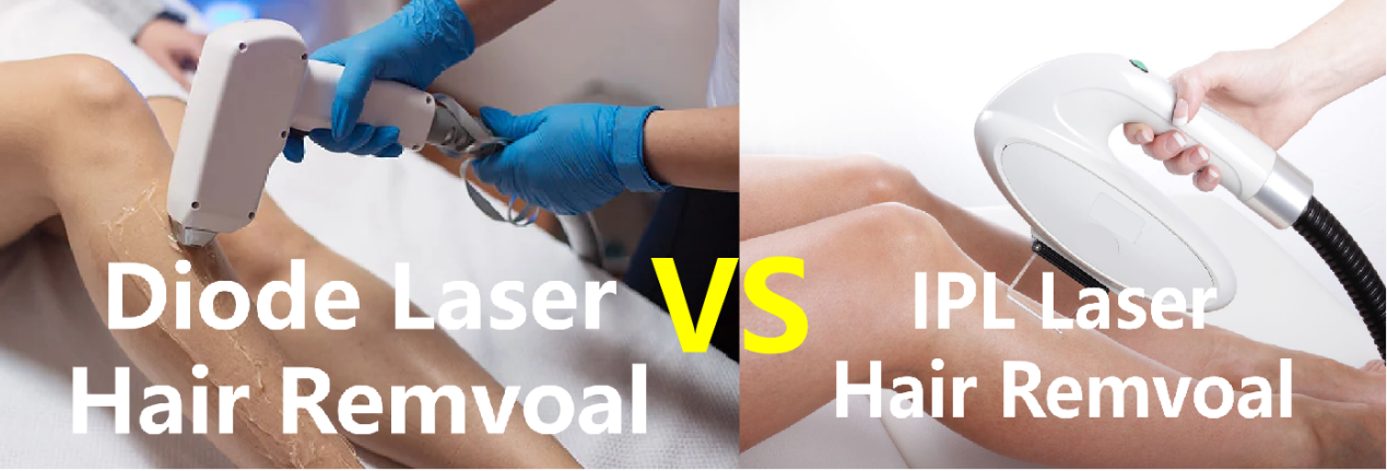 IPL vs. Diodenlaser-Haarentfernung