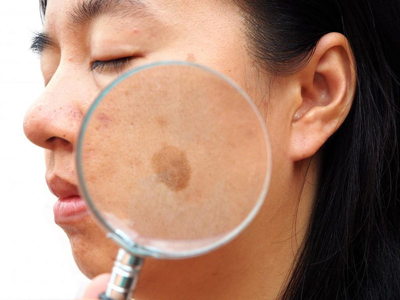 Pikosekundenlaser: Ein guter Helfer, um Melasma zu entfernen