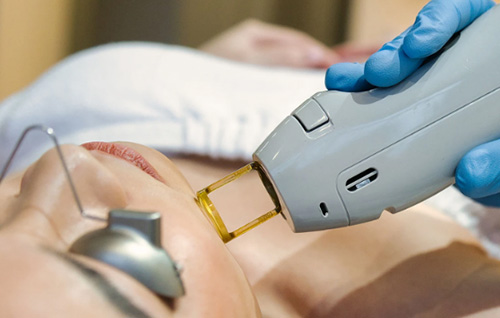 Warum wählen Sie immer mehr Kunde Alexandrite Laser, um die Haarentfernung durchzuführen?
