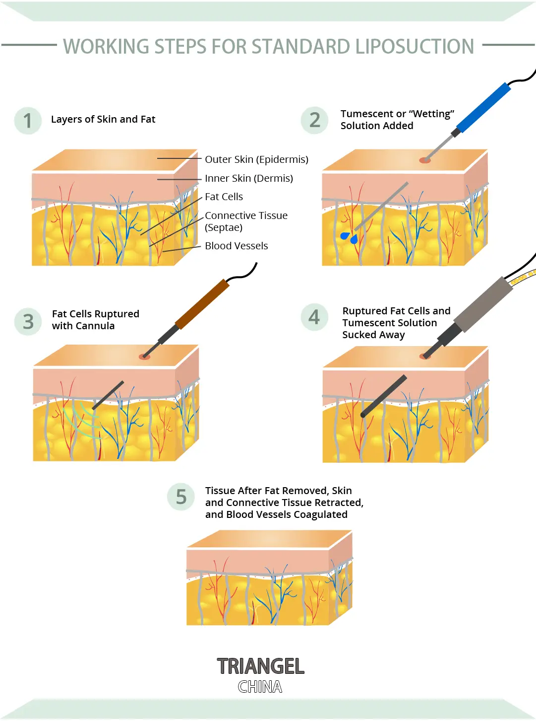 980nm 1470nmdiode Laser Lipolysis Machine