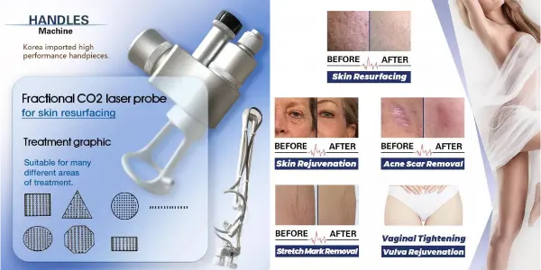 Fractional CO2 laser