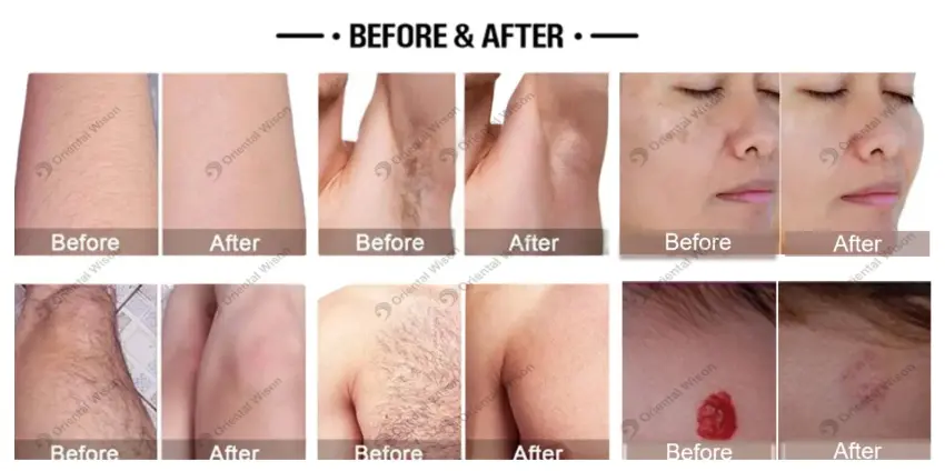 15inch Alexandrite Laser Hair Removal Beauty Machine